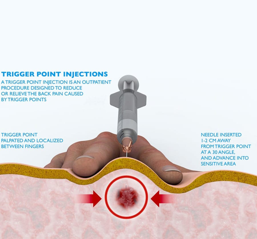 Trigger-Point-Injection-Treatment